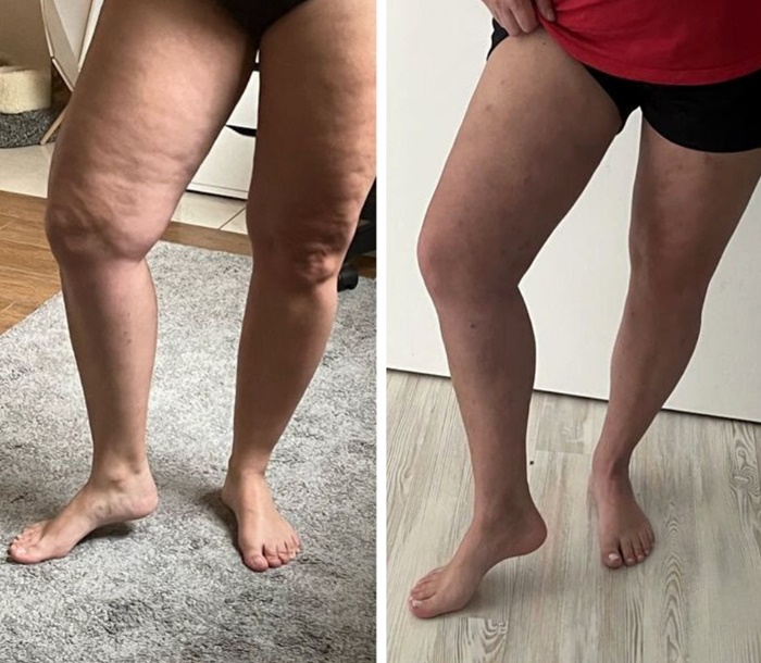 lipedema-antes-e-depois07.jpg